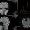 1-imágenes neuronales-imagen svs cabeza