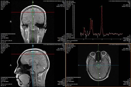 1-imágenes neuronales-imagen svs cabeza