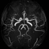 4 imágenes vasculares – cabeza vascular tof imágenes 3