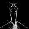 Imágenes vasculares de 4 vértebras vasculares cervicales